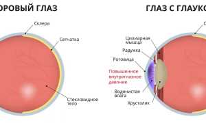 Что такое Глаукома