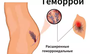 Геморрой у женщин