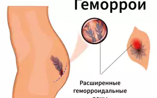 Геморрой у женщин