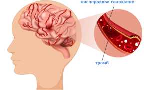 Инсульта головного мозга и его последствия