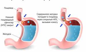 Изжога — ощущение жжения в груди или пищеводе