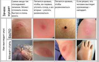 Укус овода — что делать?