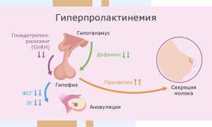 Как проявляется гиперпролактинемия