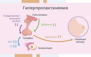 Как проявляется гиперпролактинемия