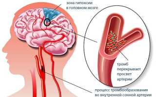 Холестериновые бляшки в сосудах