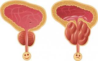 Абактериальный простатит — отличие патологии от других, признаки и терапия