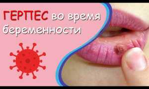 Герпес на губах при беременности