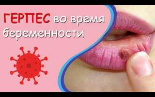 Герпес на губах при беременности