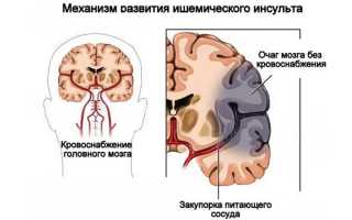 Как увеличить продолжительность жизни после инсульта восстановление и профилактика повторного приступа