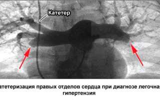 Легочная гипертензия причины, формы, проявления, как лечить