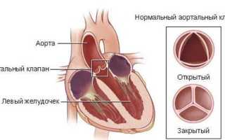 Как определить аортальный порок сердца и выявить причины