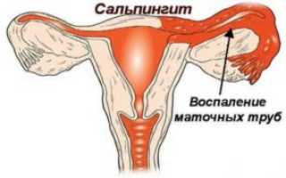 Что такое сальпингит у женщин: виды, причины, симптомы и лечение