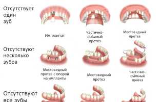 Протезирование зубов: виды и особенности зубных протезов