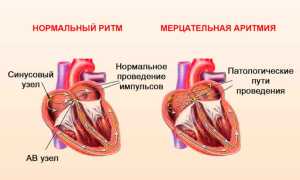 Причины аритмии сердца, правильное обследовние