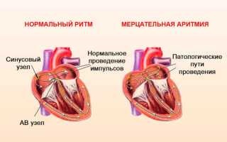 Причины аритмии сердца, правильное обследовние