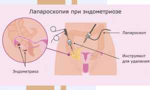 Лечение эндометриоза
