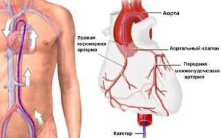 Коронарография: так ли опасны её последствия?
