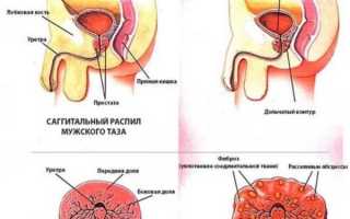 Хронический простатит – можно ли вылечить?