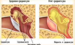 Что такое Отит