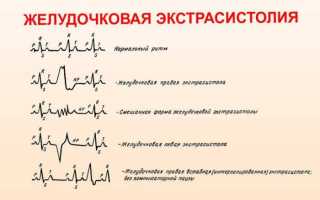 Чем опасны желудочковые экстрасистолы и как правильно их классифицировать