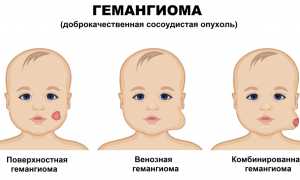 Диагностика и лечение гемангиомы