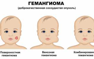 Диагностика и лечение гемангиомы