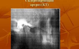 Челюстно-лицевой сустав: симптомы артроза, лечение, к какому врачу обратиться