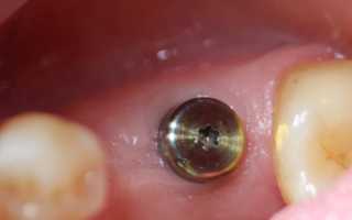 Что такое Формирователь десны