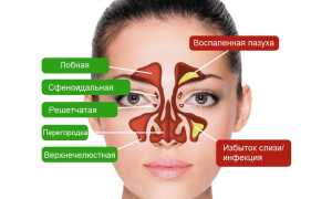 Как снизить вероятность воспаления гайморовых пазух?