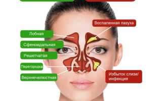 Как снизить вероятность воспаления гайморовых пазух?
