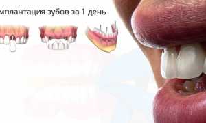 Современные методы имплантации челюсти за 1 день