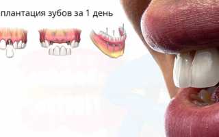 Современные методы имплантации челюсти за 1 день
