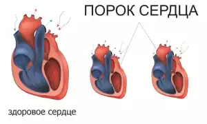 Диагностика и лечение пороков сердца у взрослых