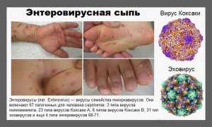 Энтеровирусная инфекция у детей