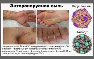 Энтеровирусная инфекция у детей
