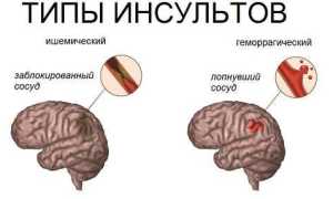 Ночные головные боли. В чем причина?