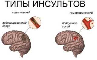 Ночные головные боли. В чем причина?
