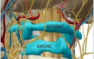 Позвонок Атлант — симптомы смещения и правка