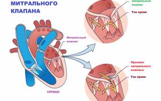 Всё, что нужно знать о пролапсе митрального клапана