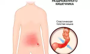 Синдром раздраженного кишечника