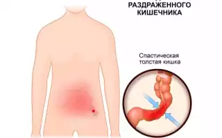 Синдром раздраженного кишечника