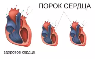 Чем может быть опасен порок сердца и как его лечить