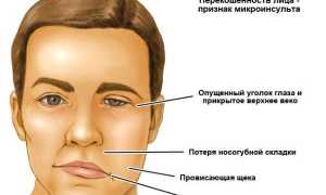 В чем отличие инсульта от микроинсульта?