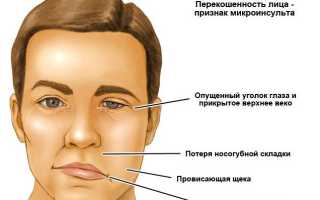В чем отличие инсульта от микроинсульта?