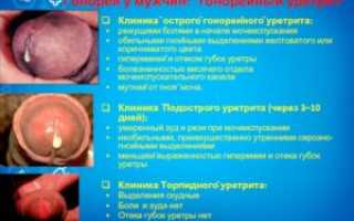 Гонорейный уретрит: что это такое, симптомы, диагностика, лечение, осложнения