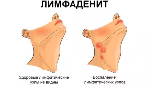 Лимфоденит: что делать?
