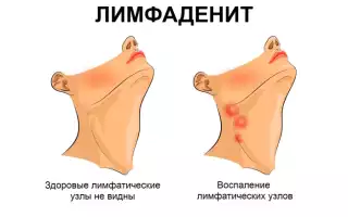 Лимфоденит: что делать?