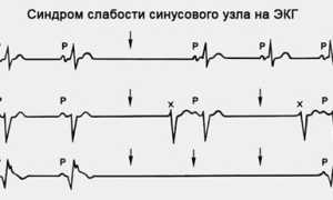 Что такое синдром слабости синусового узла