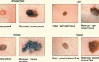Как отличить родинку от папилломы: характеристики, особенности, опасность