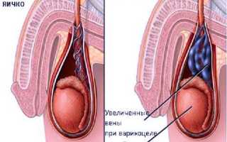 Варикоцеле, лечение народными средствами